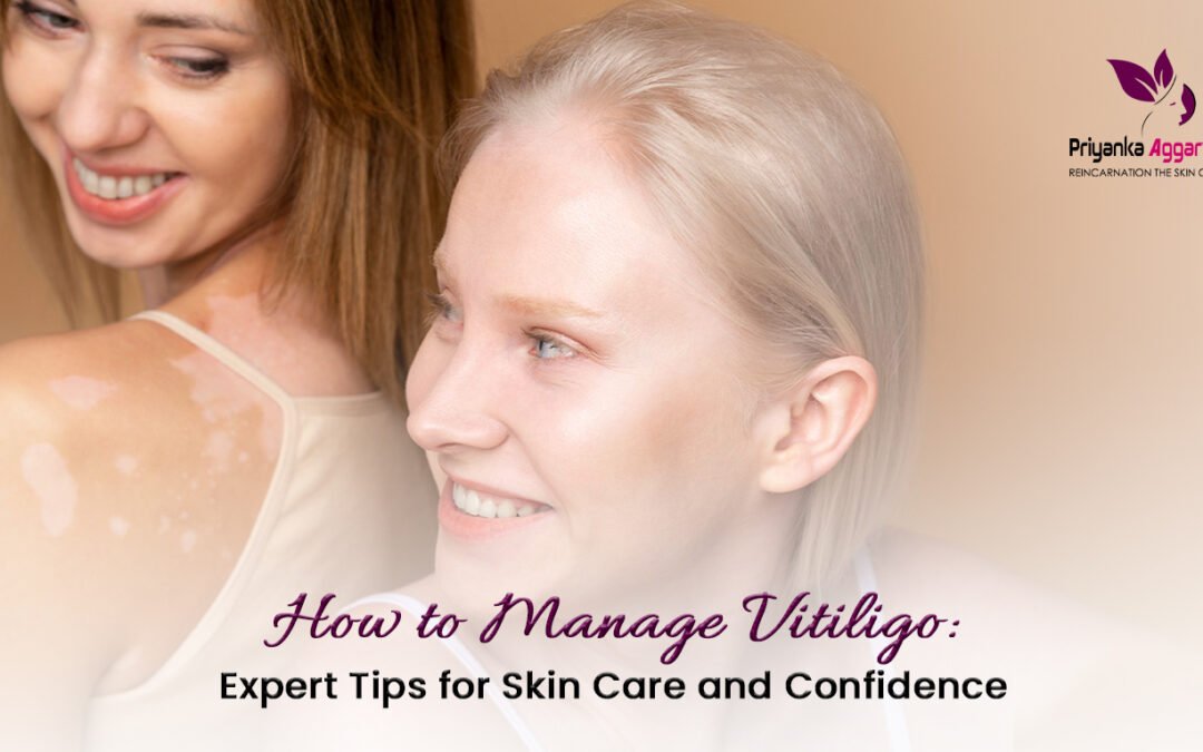 How to Manage Vitiligo: Expert Tips for Skin Care and Confidence