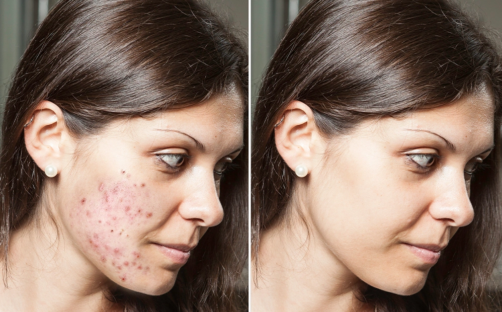 Fillers Treatment
