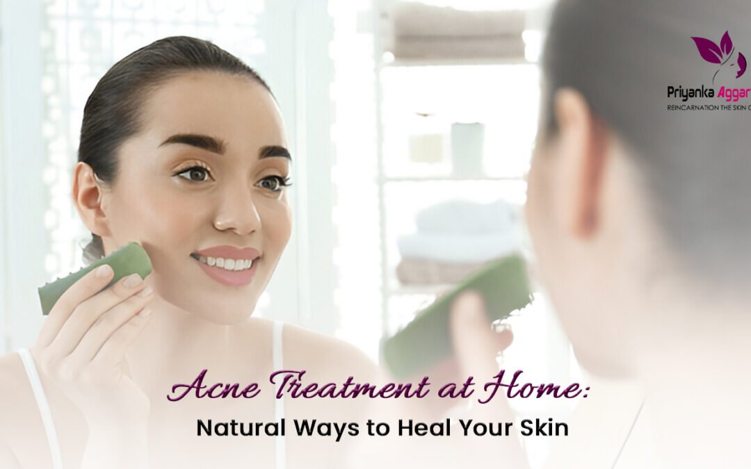 acne treatment at home