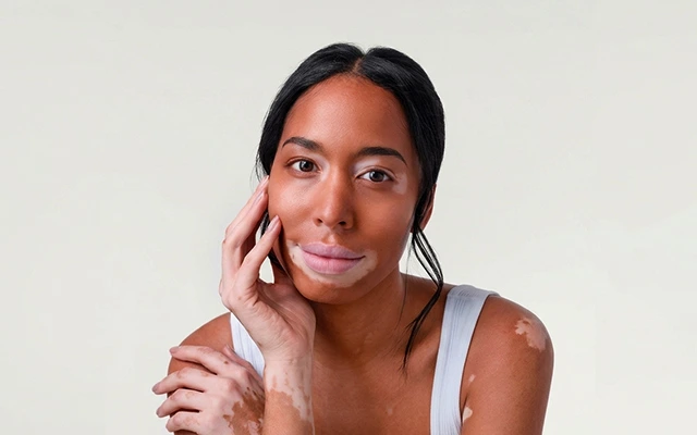 Preparing for vitiligo surgery: Evaluation, planning, and expectations