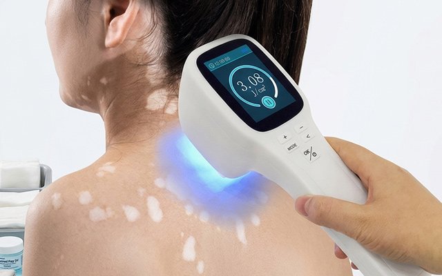 Can Targeted UV Light Really Bring Back Your Skin Colour? The Truth About Excimer Laser for Vitiligo