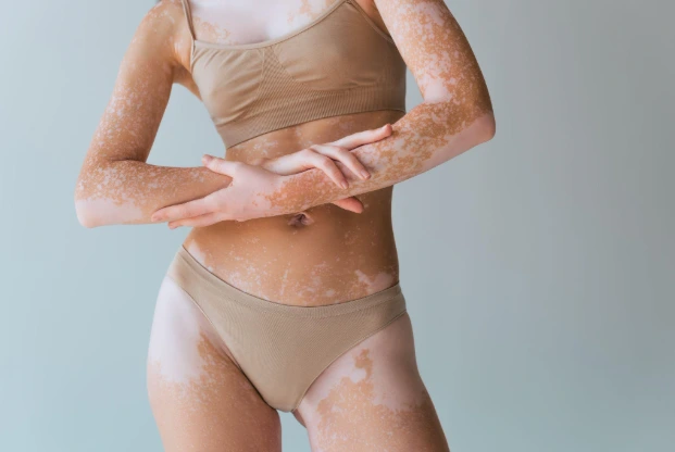 Can Targeted UV Light Really Bring Back Your Skin Colour? The Truth About Excimer Laser for Vitiligo Excimer Laser Treatment for Vitiligo